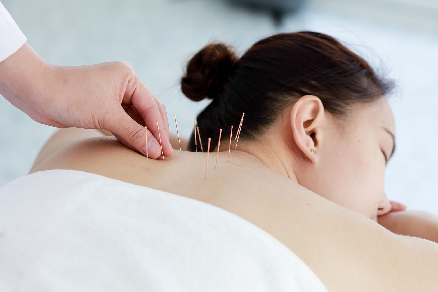 Acupuncture and Moxibustion